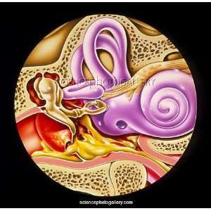  Illustration showing otitis media in middle ear Framed 